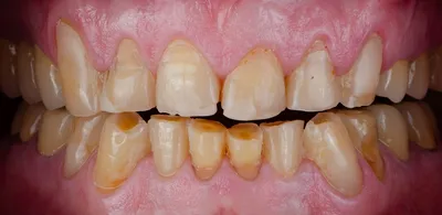 Стоматологическая детская патология, медицинская стоматологическая модель  зубов, патологическая модель, стоматологический материал, стоматологические  инструменты, стоматологическая лабораторная модель | AliExpress