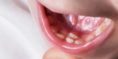Аномалии (патологии) зубов - причины, классификация, диагностика, лечение