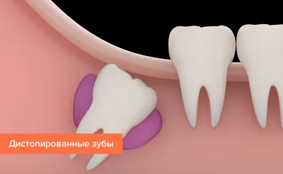 Почему стираются зубы, что делать, как лечить стираемость зубов