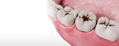 Патологии зубов и эмали | Стоматологическая клиника Слаутинского