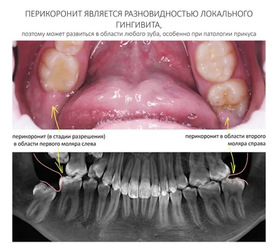 Прозрачная ортодонтия с Eurokappa - Макро- и микродентия зубов — очень  частая патология среди ортодонтических пациентов. При этом «ортодонтически»  вылечить размер зубов невозможно, поэтому врач не может просто закрыть  промежуток там, где