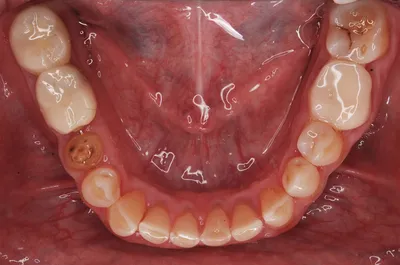 Патологическая стираемость зубов и методы восстановления | Стоматология  Дентал Мир