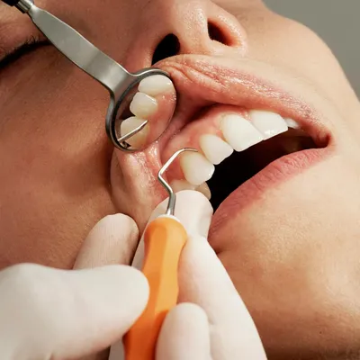 Сложное удаление зуба - нюансы операции - Стоматология ЭспаДент