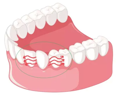 Клиновидный дефект зубов: что это такое?