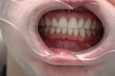 Лечение патологической стираемости зубов - Стоматология Набережные Челны -  DENTAL FORTE \"Дентал Форте\"