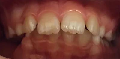 Протрузия зубов – такой вид... - Sevil Home Clinic | Facebook