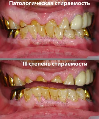 Стираемость зубов норма или патология?