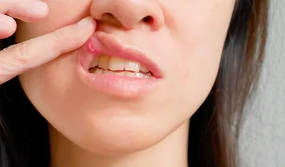 Лечение патологической стираемости зубов - Стоматология Набережные Челны -  DENTAL FORTE \"Дентал Форте\"