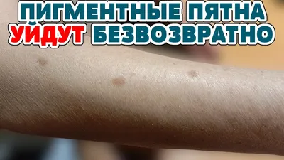 Пигментные пятна на руках: как убрать и 4 причины появления