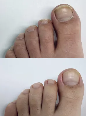 Фотографии наращивания ногтей на ногах из портфолио специалистов на Профи