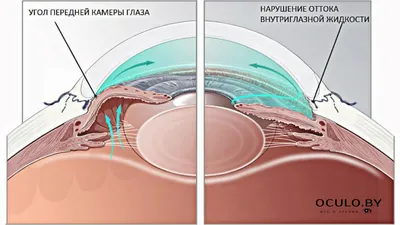 Передняя камера глаза