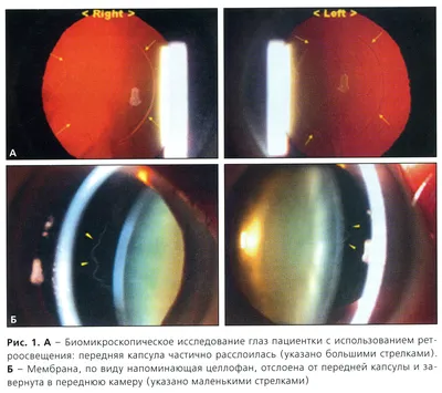 Рис. 1. А — Биомикроскопическое исследование глаз пациентки…