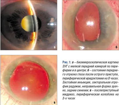Рис 1. А – биомикроскопическая картина ЗУГ с мелкой передней камерой п…