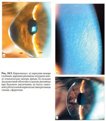 Рис. 10.5. Кератоконус: а) передняя камера глубокая, вершина роговицы …