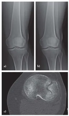 Closed Fractures of the Distal Part of the Shin Bones. Different Types and  Methods of the Treatment in Adolescence. Short Period Results - Dorokhin -  Physical and rehabilitation medicine, medical rehabilitation