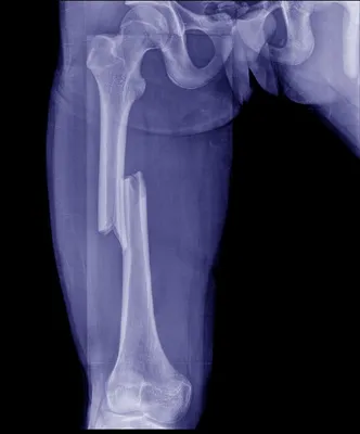 Переломы пястных костей – Fractura.ru
