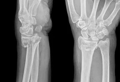 Перелом пяточной кости с осколками и смещением | Пикабу