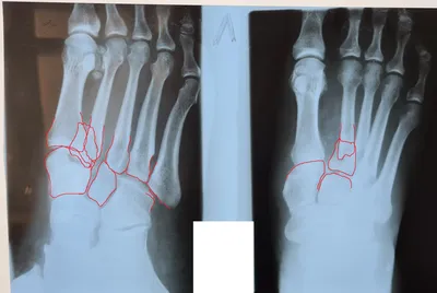 Перелом пяточной кости с осколками и смещением | Пикабу