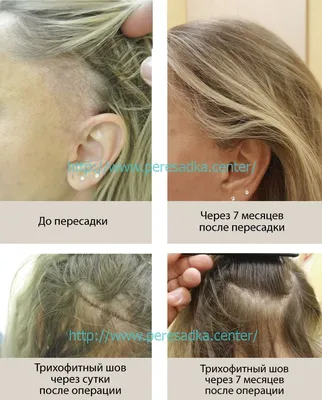 Мария Погребняк: пересадка бровей в Real Trans Hair