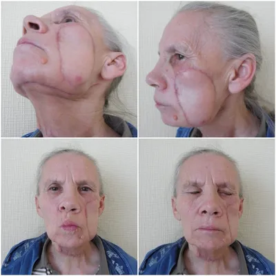 Реконструкция кожных покровов лица | NEOPLASTY