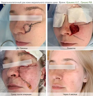 В Самаре врачи восстановили женщине сгоревшее лицо - 17 июня 2020 - 63.ru
