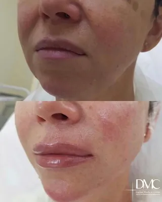 Пересадка кожи лица | Теория идеи - YouTube