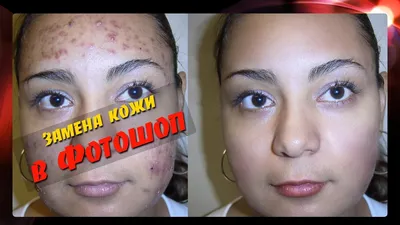 Фото до и после дерматологии | Damas Medical Center