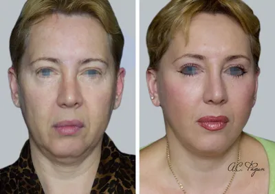 Пересадка лица: до и после | Пикабу