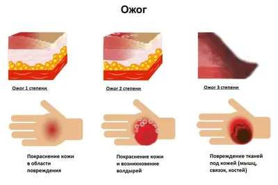 Криодеструкция в Киеве на Печерске - Coolaser Clinic