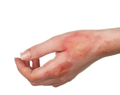 Лечение рубцов после ожогов и травм: пластика, фото до и после |  Интернет-журнал Estetmedicina.ru