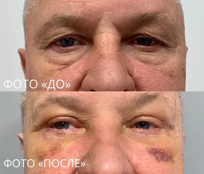 Искусственную кожу пересадили павлодарцу после ожога - Телеканал «Астана»