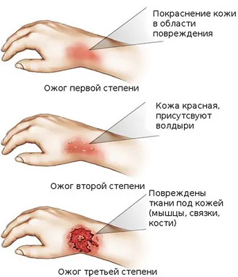 ПРОБЛЕМЫ С КОЖЕЙ ПОСЛЕ ОЖОГА - статьи о здоровье