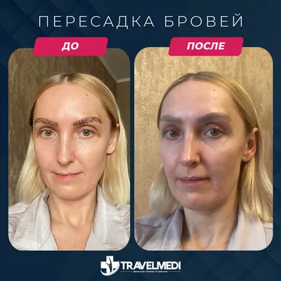 Пересадка волос — Tair