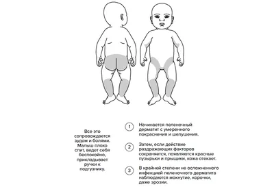 Перианальный инфекционный дерматит (ПИД). - Блог врача Олега Конобейцева