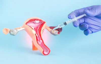 Миниинвазивная перинеопластика (вагинопластика)