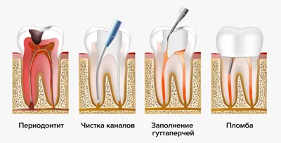 Периодонтит - что это, осложнения, лечение -