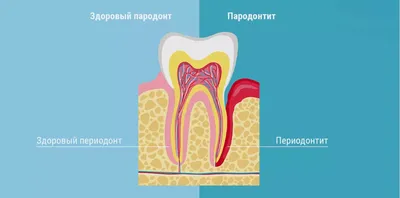 Лечение периодонтита зуба с несформированными верхушками корней - детская  стомалогия Nikadent Family