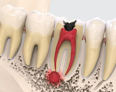 Периодонтит – что это и как его избежать. Рассказывают врачи-стоматологи. |  New York Dental Center | Дзен