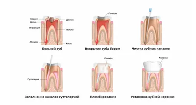 Периодонтит – Dental Clinic