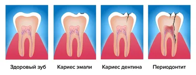 Лечение периодонтита в стоматологической клинике SmileOnline, СПб