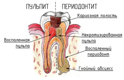 Лечение периодонтита в Тюмени, лечение воспалительных процессов каналов зуба