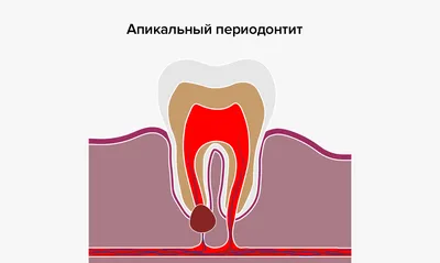 Периодонтит | Стоматология Бескудниково