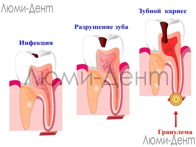 Лечение периодонтита в Москве — диагностика, цена от 6600 ₽