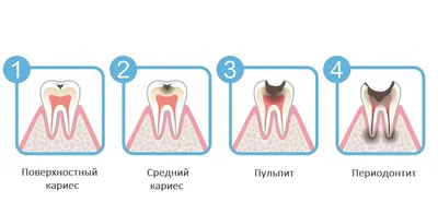 Spectrum - Лечение периодонтитов