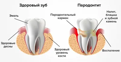 Лечение периодонтита зуба со сформированными верхушками корней - детская  стомалогия Nikadent Family