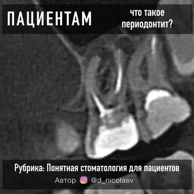 Лечение пульпита и периодонтита - стоматология Эскулап в Красноярске