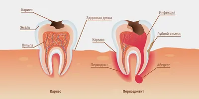 Периодонтит — DENTAKS | ДЕНТАКС