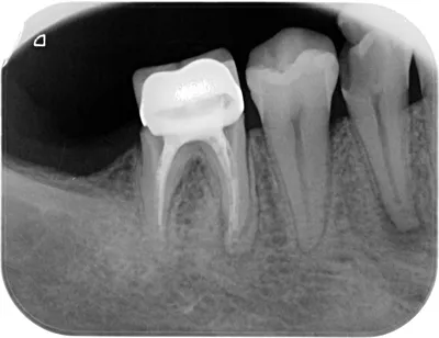 Мифы о стоматологии. Чем опасен пародонтит?