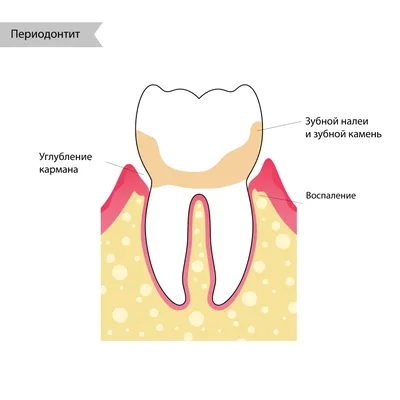 Чем отличаются пульпит и периодонтит | ✓Стайл-С: понятная стоматология  |Москва — Отрадное| | Дзен