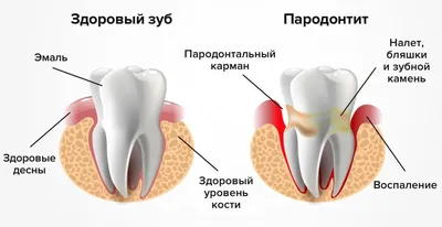 Лечение всех видов периодонтита постоянных зубов